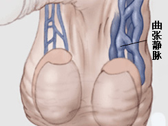 精索靜脈曲張