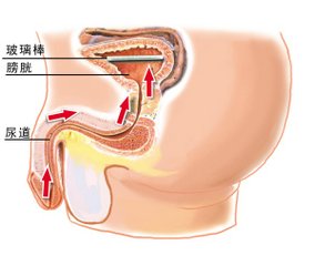 尿道畸形