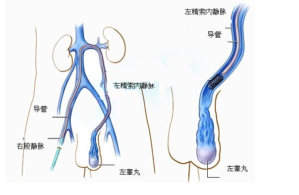 精索靜脈曲張的病因有哪些